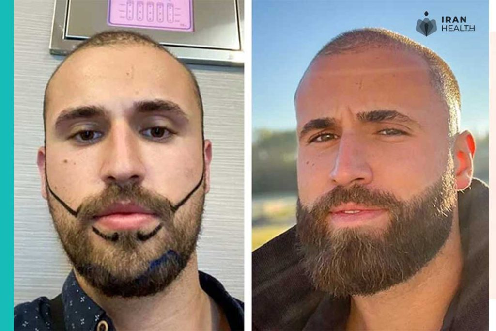 What is Bad About Beard Transplant:
