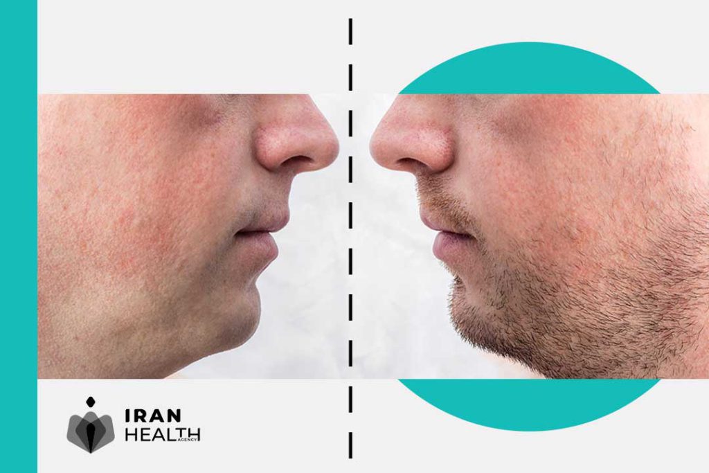Who can be a good candidate for beard transplant in Iran?