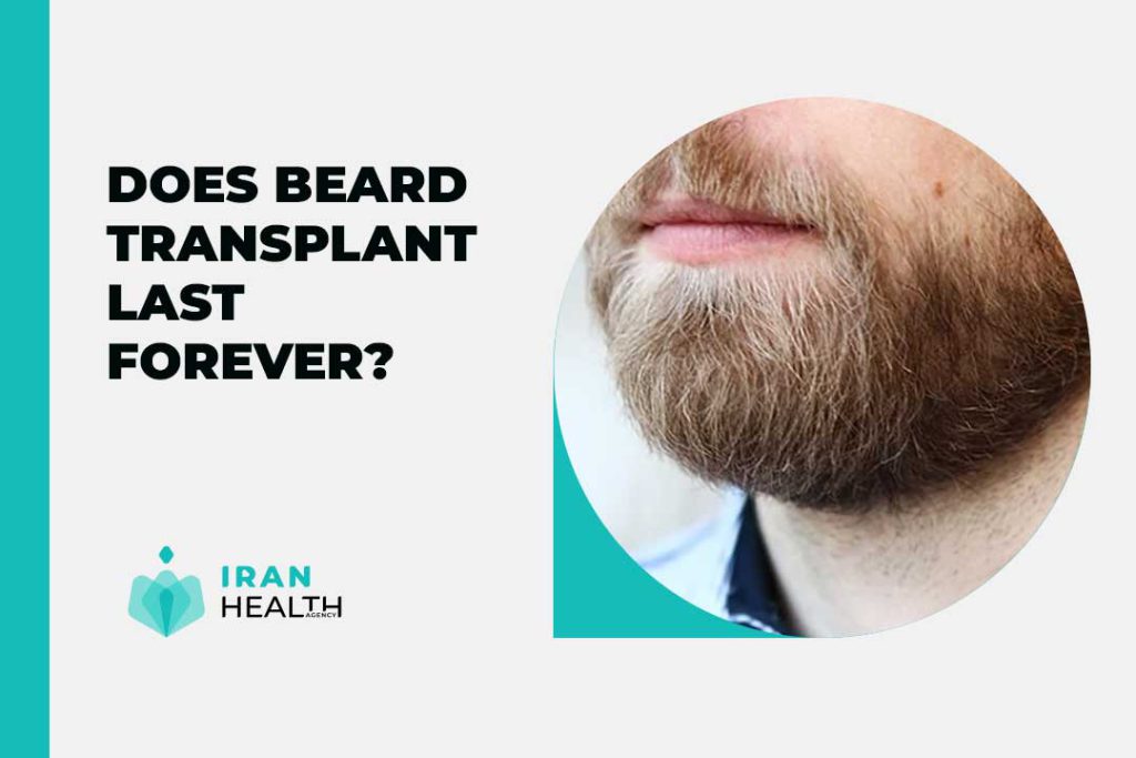 Does beard transplant last forever?