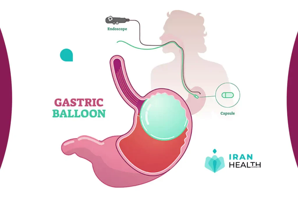 Gastric balloon surgery