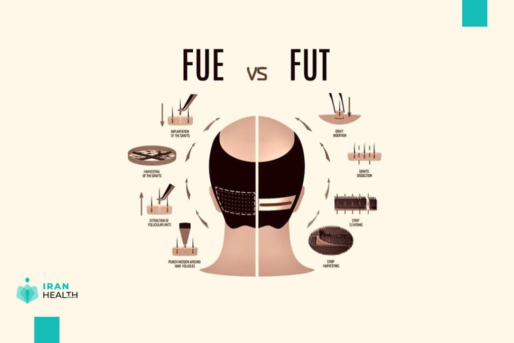 What is the FUE technique?