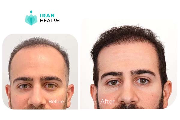 hair transplant in iran before after photos