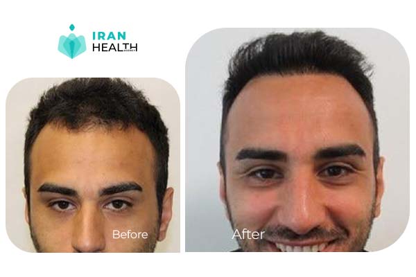 hair transplant in iran before after photos