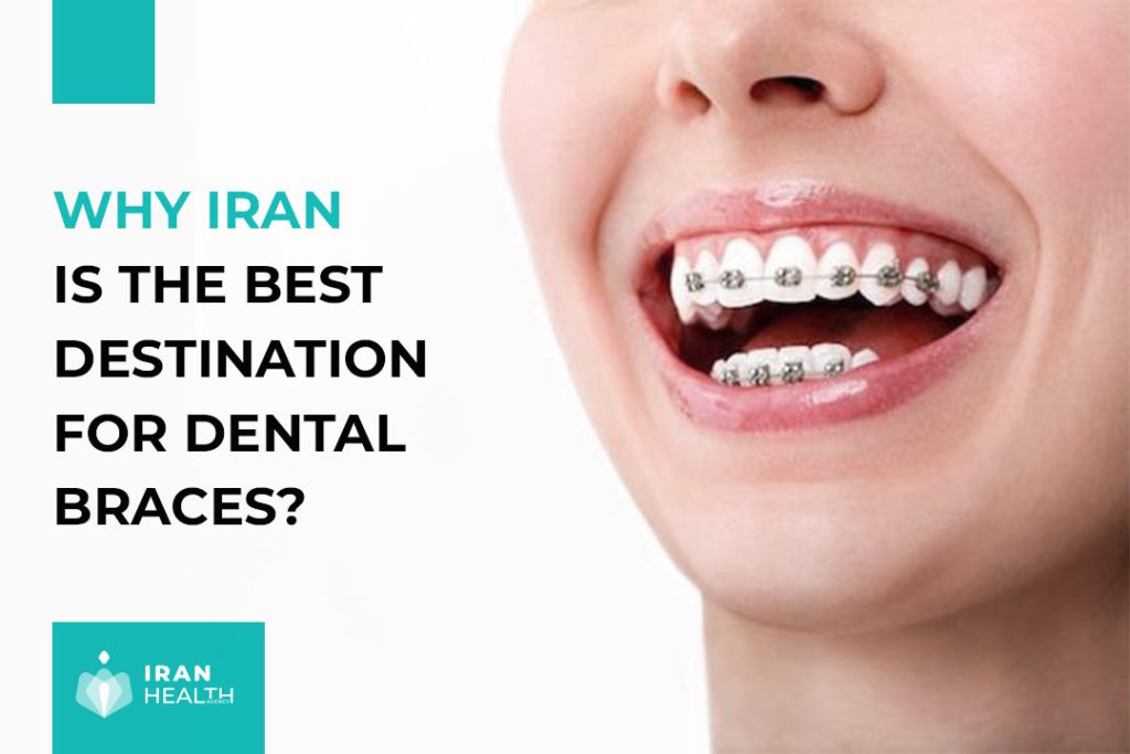 Why Iran is the Best Destination for Dental Braces