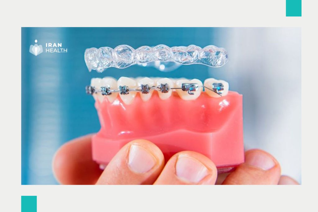 How to Get Affordable and High-Quality Dental Braces
