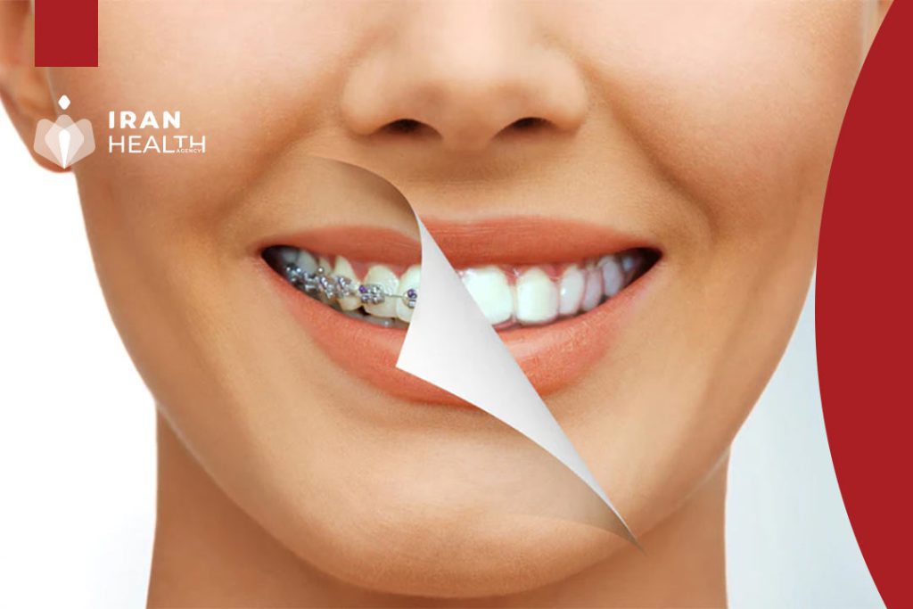 Dental Braces in Iran: Everything You Need to Know Before You Go