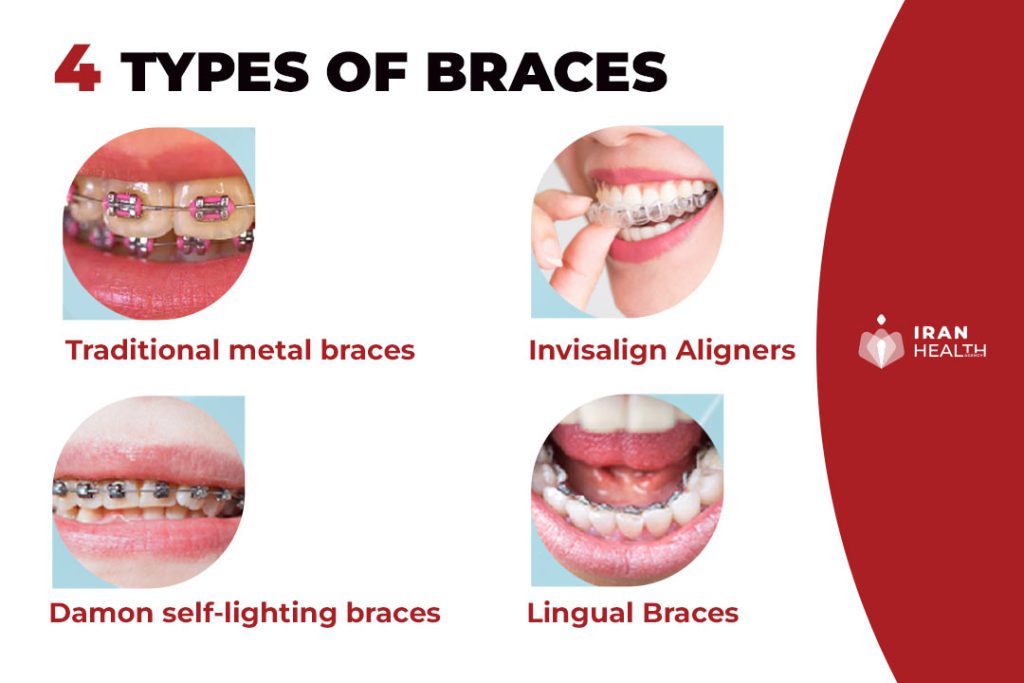 Main types of orthodontic treatments