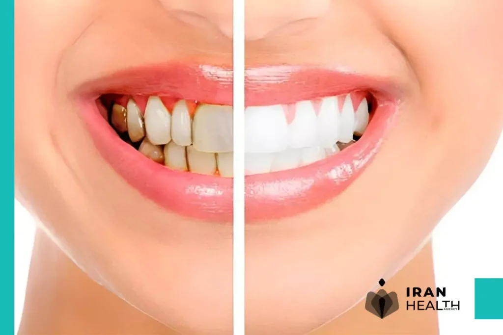 What is Teeth whitening?