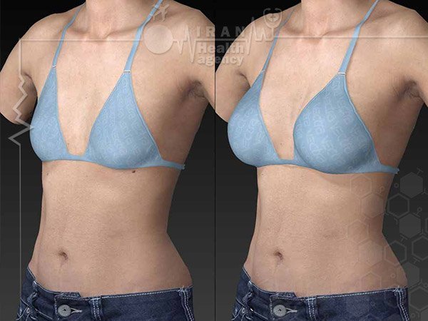 Breast lift iran