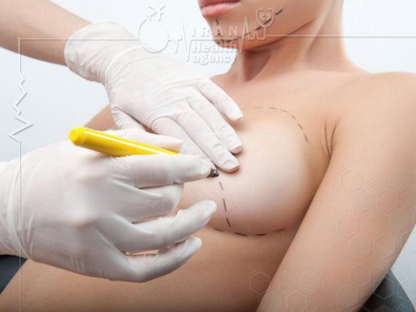 Breast surgery in iran