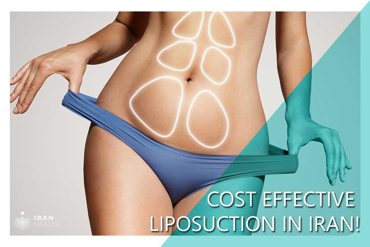 Cost effective Liposuction in Iran