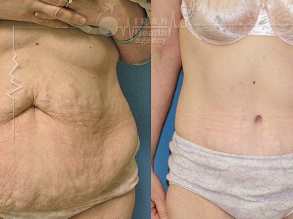 Lipoabdominoplasty in iran