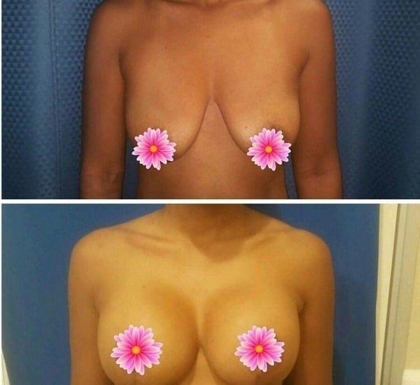 breast lift in Iran