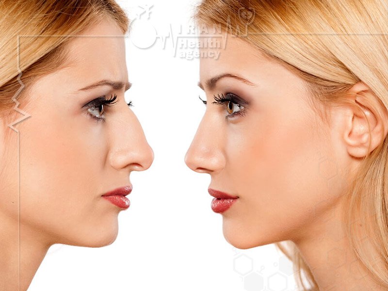 great nose job in iran health agency