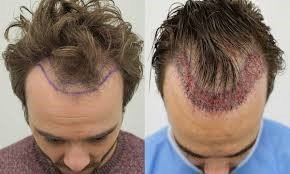 hair transplant in Tehran