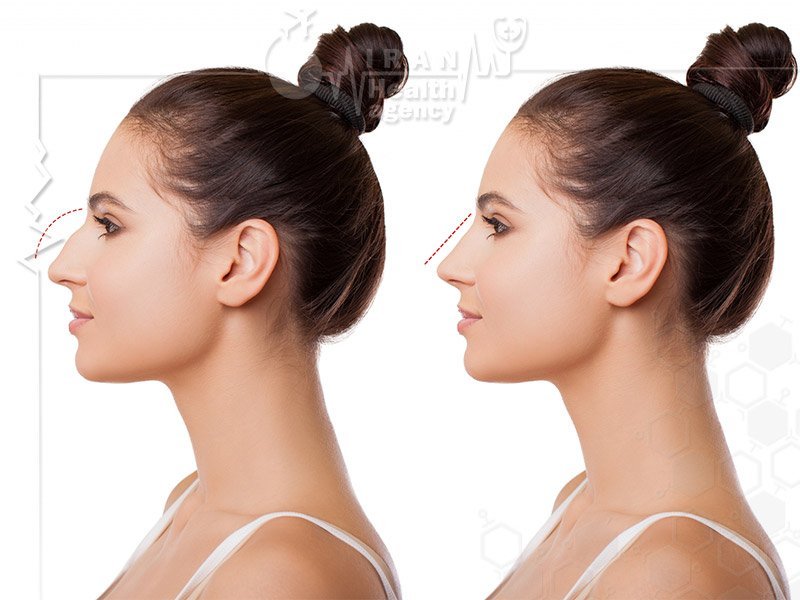 rhinoplasty in iran for women