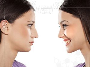 rhinoplasty iran