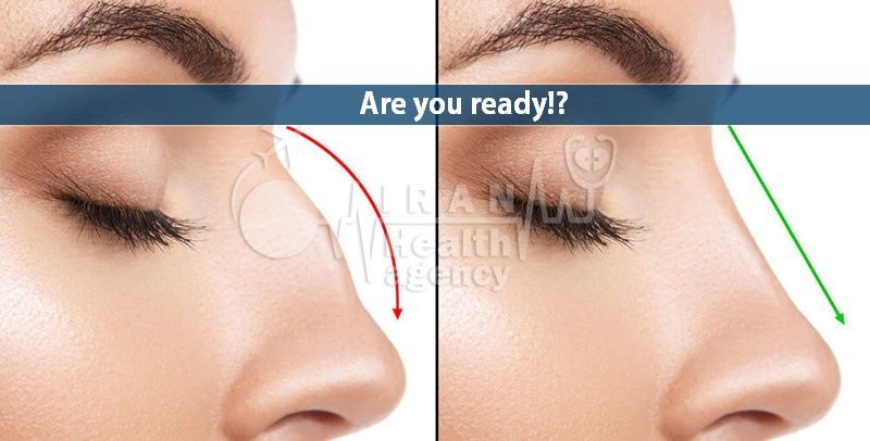 revision Rhinoplasty revision Rhinoplasty