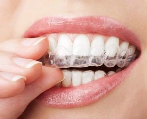 Invisalign orthodontic iran health agency