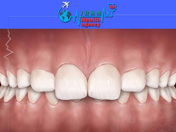 Over bite or deep bite orthodontics