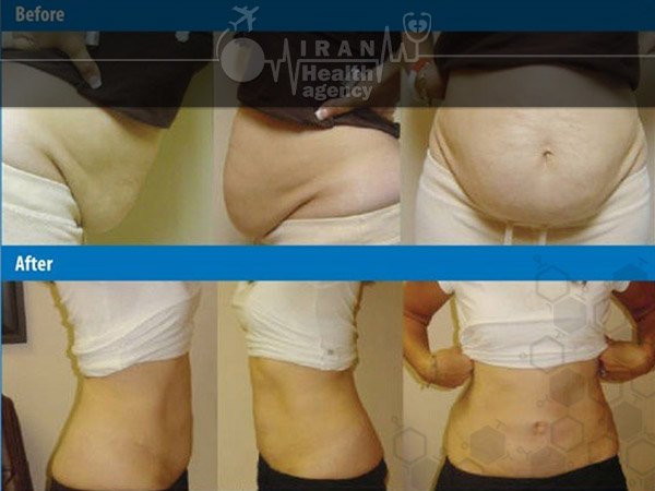 Tummy Tuck in Iran liposuction