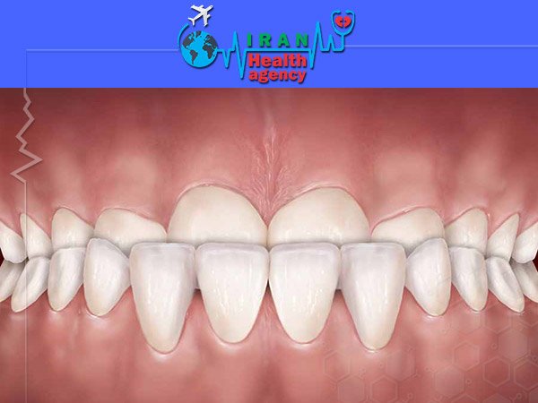 Under bite orthodontics