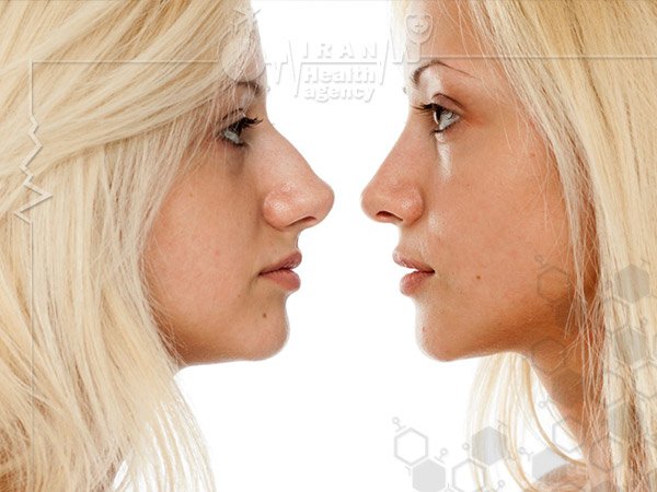 before after rhinoplasty