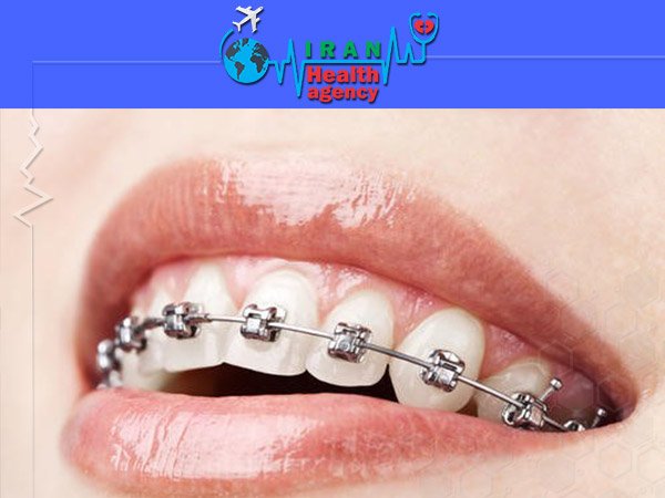 fixed orthodontic iran health agency