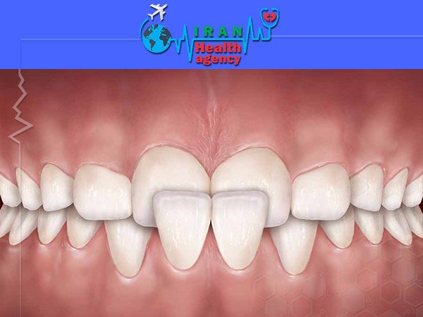 orthodontic for Cross bite