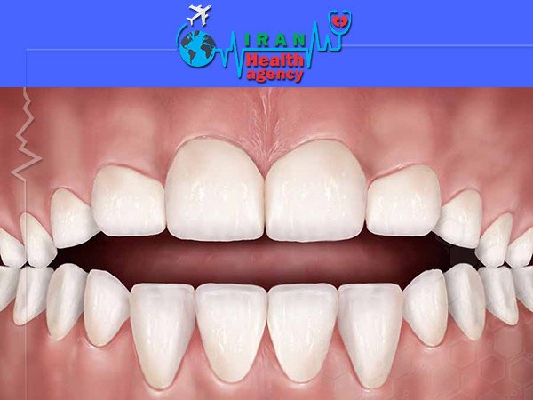 orthodontic for Open bite