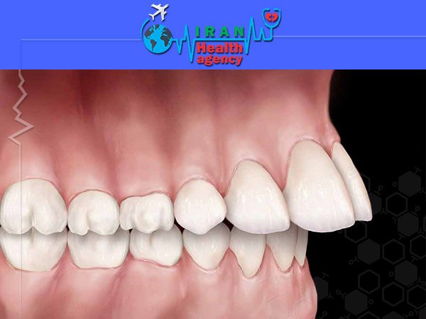 orthodontic for Overjet