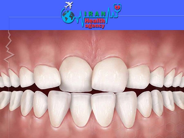 orthodontic for Teeth congestion