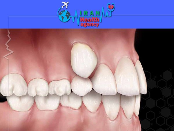 orthodontic for ectopic position