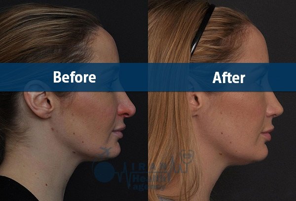 revision rhinoplasty before after in iranhealthagency