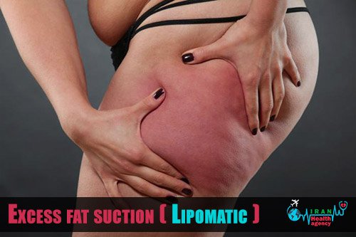 Excess fat suction