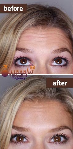 before and after botox