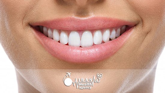 dental veneers in ahvaz