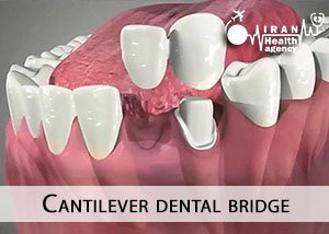 Cantilever dental bridge