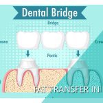 Dental bridges in Iran