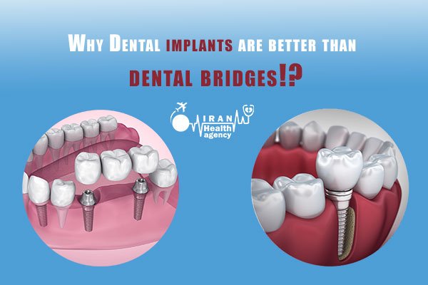 Dental implants and dental bridges