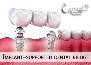 Implant-supported dental bridge