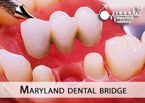 Maryland dental bridge