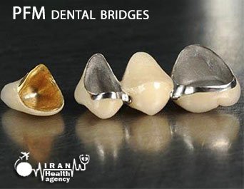 PFM dental bridges