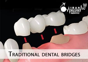 Traditional dental bridges
