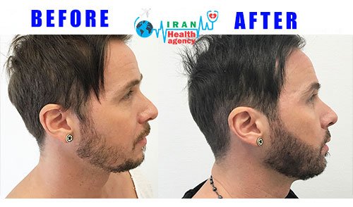 beard transplant BEFORE and AFTER