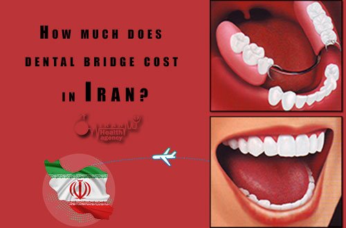 dental bridge cost
