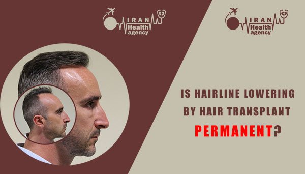 Is hairline lowering by hair transplant permanent