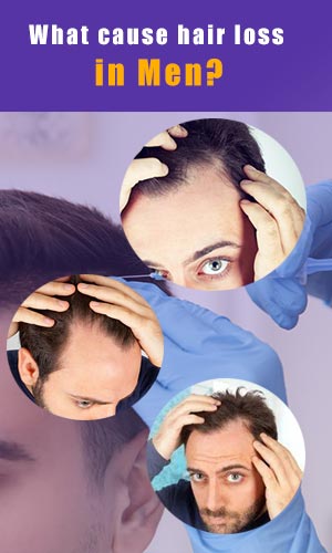 hair loss in men