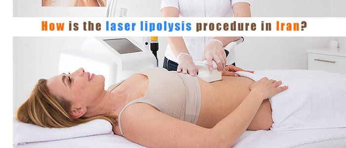 How is the laser lipolysis procedure in Iran