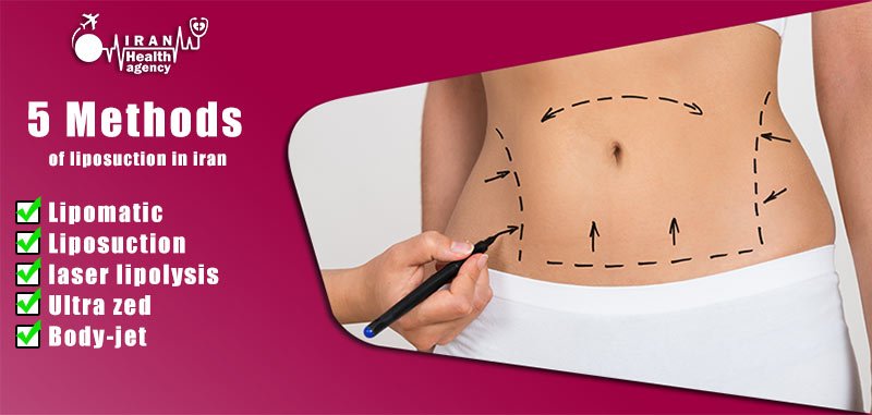 Methods of liposuction or Lipomatic in Iran